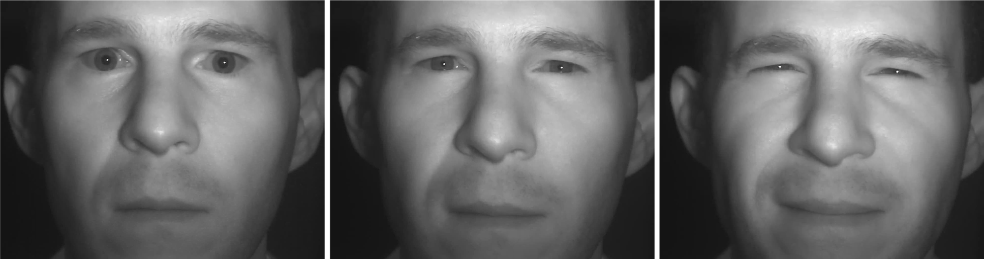 Video responses of facial muscles to light in a migraine patient