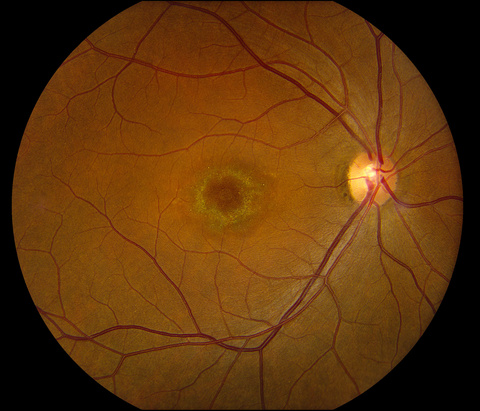 Macular Atrophy