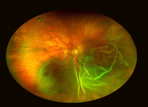 Retinal Detachment
