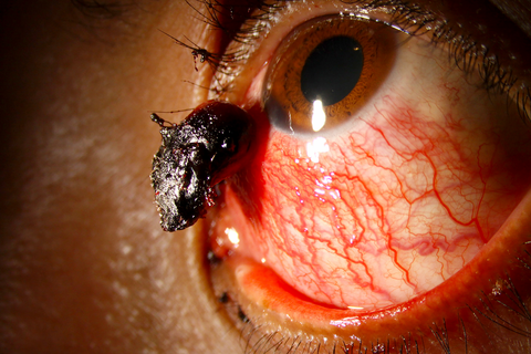 Malignant Neoplasm of Conjunctiva