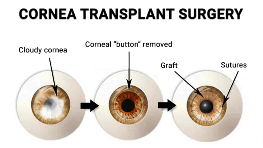 Cornea Transplant Process